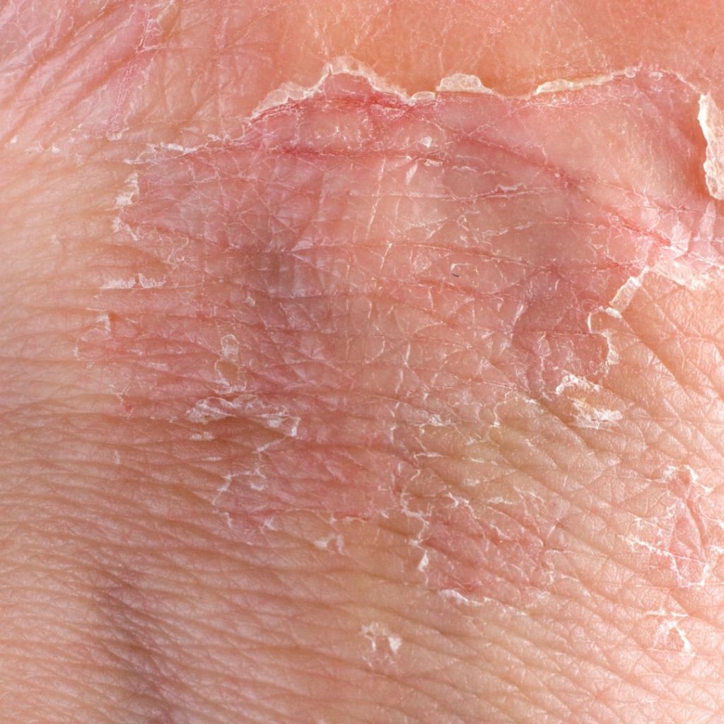 Gambar kulit kering merekah - eczema