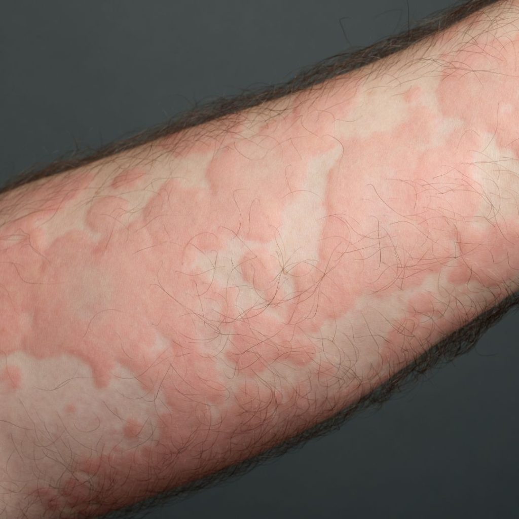 Gambar kulit merah bengkak di tangan - urticaria