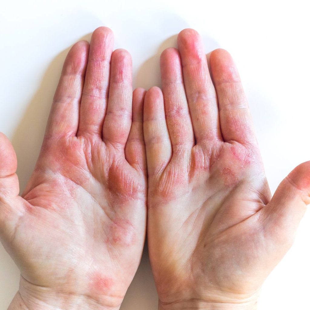 Gambar kulit merah di tangan - dermatitis