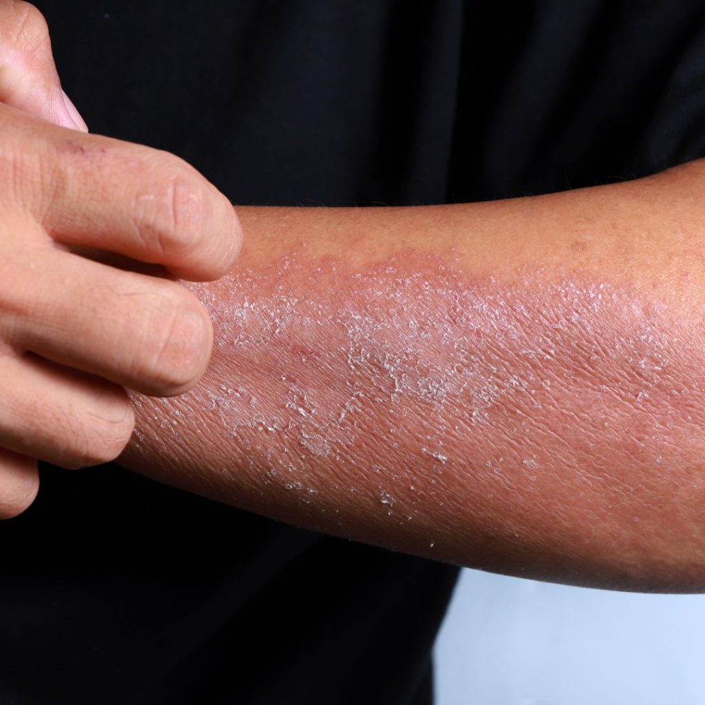 Gambar kulit merah kering merekah di tangan - eczema