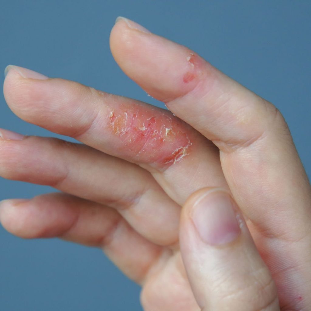 Gambar kulit merah merekah di jari - dermatitis